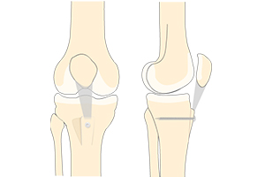 Patella Stabilisation Icon
