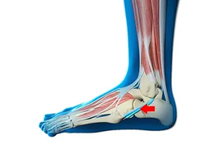 Peroneal Tendon Dislocation Icon