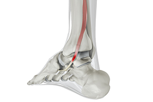 Posterior Tibial Tendon Dysfunction Icon