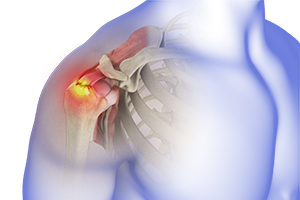 Rotator Cuff Tear Icon