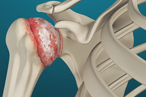 Arthritis of the Shoulder Icon