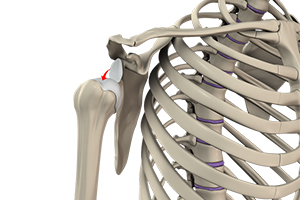 Shoulder Dislocation Icon