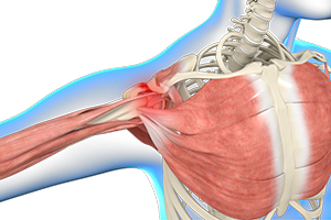 Impingement Syndrome Icon