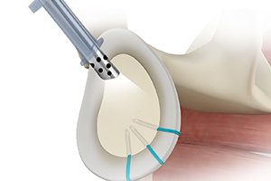 Shoulder Reconstruction Surgery  Icon