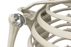 Shoulder Resurfacing  Icon