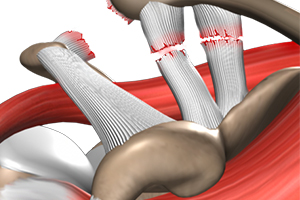 Shoulder Separation  Icon