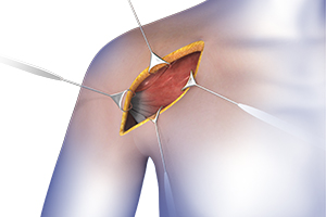 Shoulder Surgery  Icon