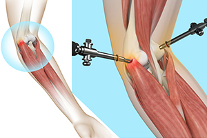 Tennis Elbow Surgery Icon