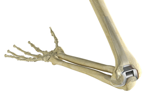 Total Elbow Replacement Icon