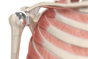 Total Shoulder Replacement Icon