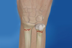 Wrist Fractures Icon