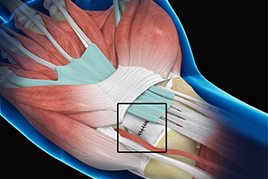 Wrist Ligament Reconstruction Icon