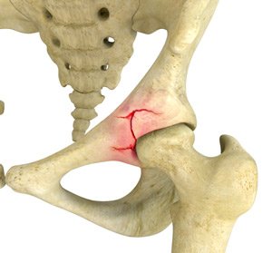 Acetabular Fracture pic