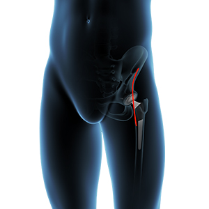 Direct Anterior Hip Replacement pic