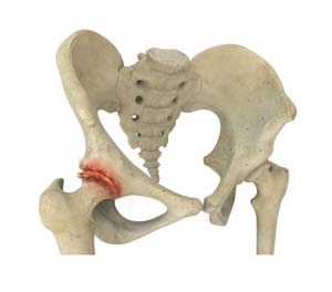 Osteoarthritis of the Hip pic