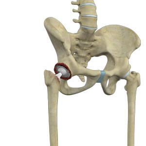 Revision Hip Surgery pic