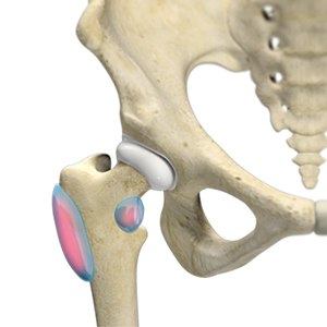 Trochanteric Bursitis pic
