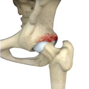 Acetabular Pincer Deformity-img