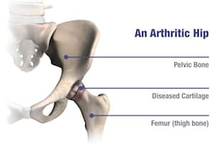 Anterior Approach Hip Replacement