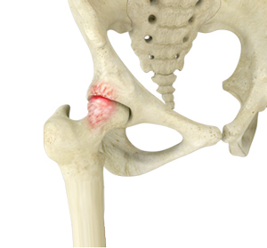 Femoroacetabular Impingement-img