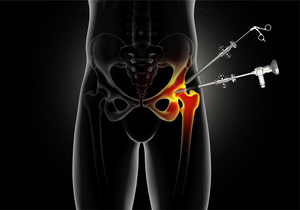 Hip Surgery-img