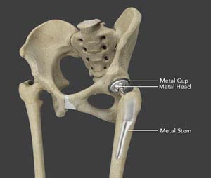 Primary Hip Replacement-img