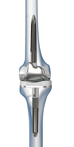 Robotic-Assisted Revision Knee Replacement