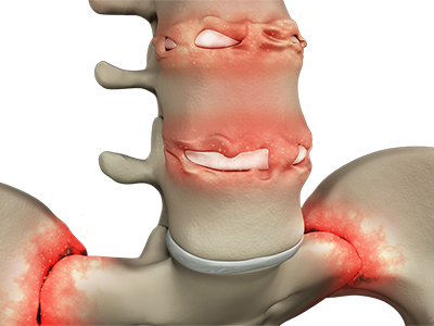 Ankylosing Spondylitis - Educational Photo