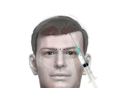 Botox for Headache and Muscle Pain - Educational Photo