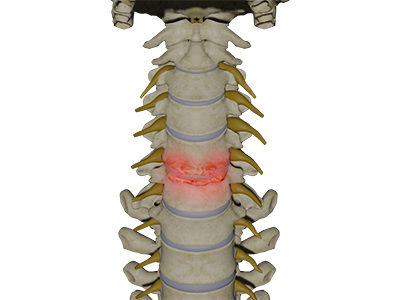 Cervical Degenerative Disc Disease - Educational Photo