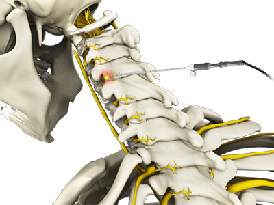 Cervical Facet Radiofrequency Neurotomy - Educational Photo