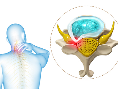 Cervical Radiculopathy/Myelopathy - Educational Photo