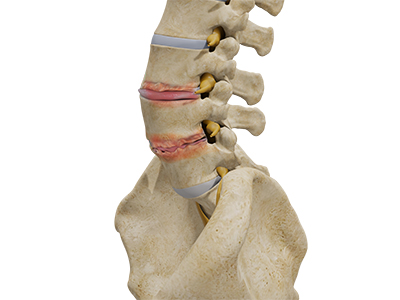 Degenerative Disc Disease - Educational Photo