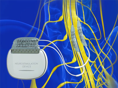 Dorsal Root Ganglion Trial - Educational Photo