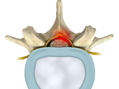 Epidural Blood Patch - Educational Photo