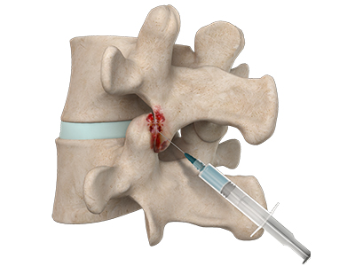 Facet Injections - Educational Photo