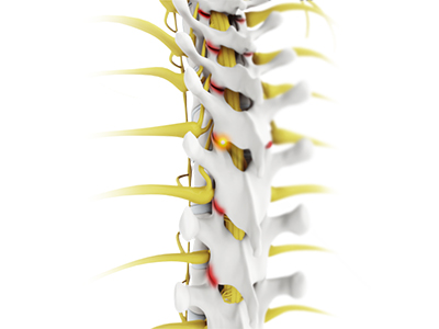 Facet Joint Arthritis - Educational Photo