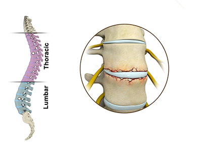 Fracture of the Thoracic and Lumbar Spine - Educational Photo