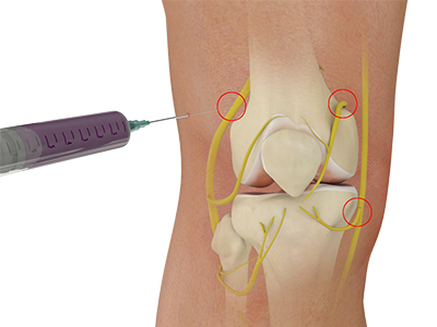 Genicular Nerve Block - Educational Photo