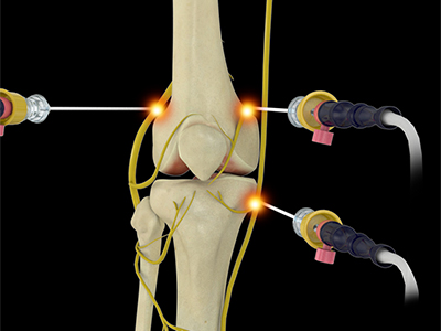 Genicular Nerve Radiofrequency Ablation - Educational Photo