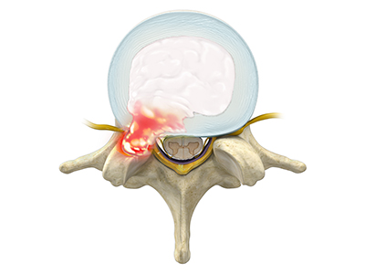 Herniated Disc (Lumbar) - Educational Photo