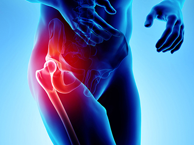 Hip Pain - Educational Photo