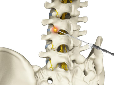 Interventional Pain Management - Educational Photo