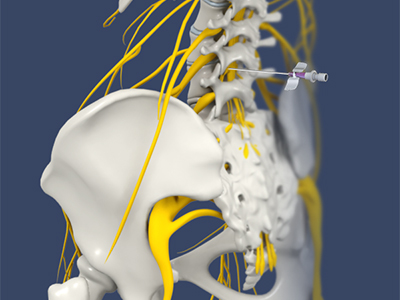 Lumbar Sympathetic Block - Educational Photo