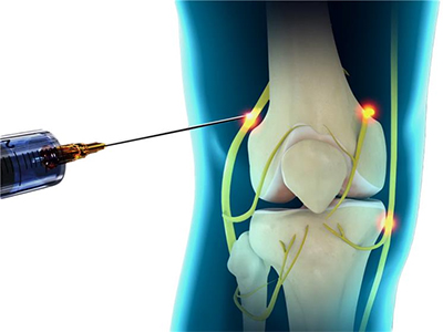 Peripheral Nerve Blocks for Joint Pain - Educational Photo