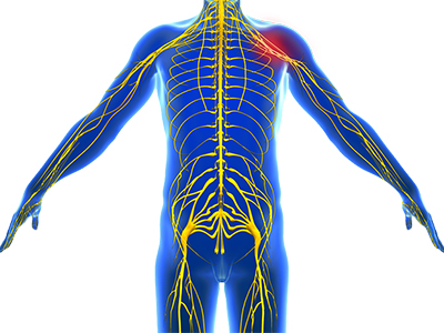 Peripheral Nerve Compression - Educational Photo