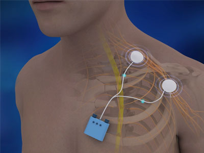Peripheral Nerve Stimulation - Educational Photo