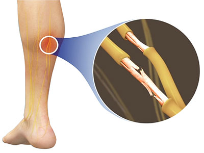 Peripheral Neuropathy - Educational Photo