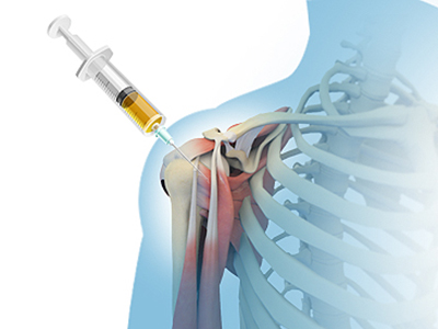 Platelet-Rich Plasma (PRP) Injection - Educational Photo