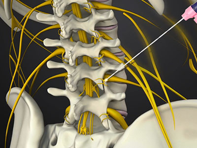 Lumbar Facet Radiofrequency Ablation - Educational Photo